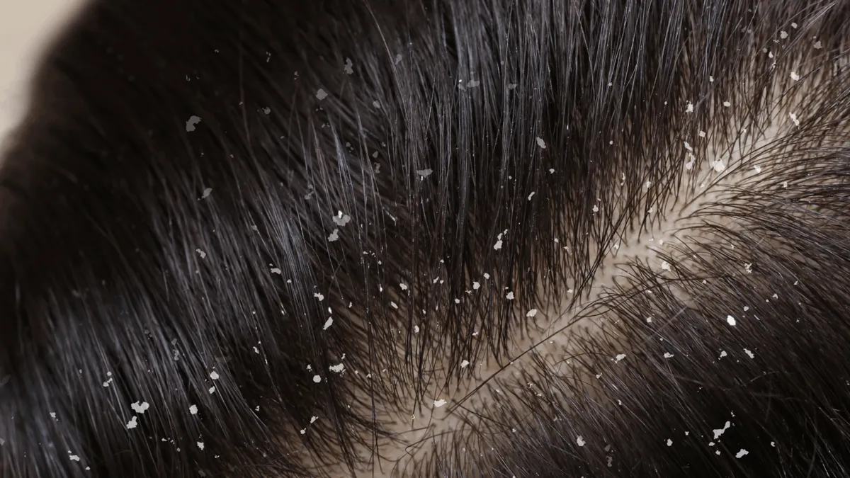 Dandruff in Saudi Arabia: Why It’s So Common & How to Get Rid of It Naturally 2025